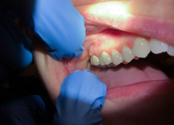 Best Dentist for Tooth Abscess  in Humboldt, KS