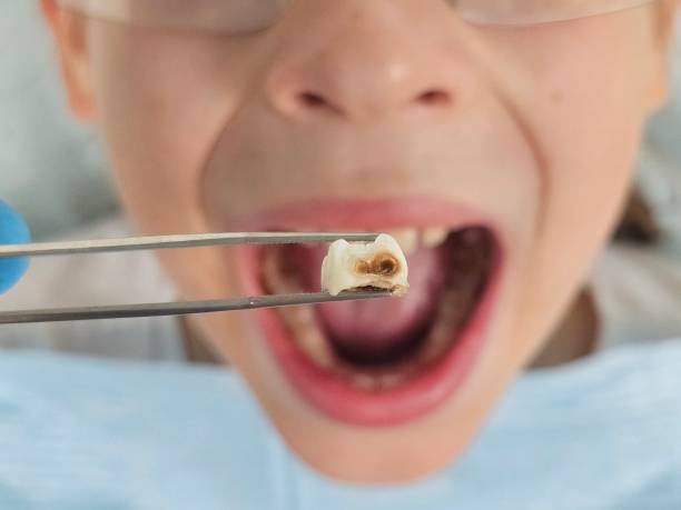 Best Root Canal Emergency Dentist  in Humboldt, KS